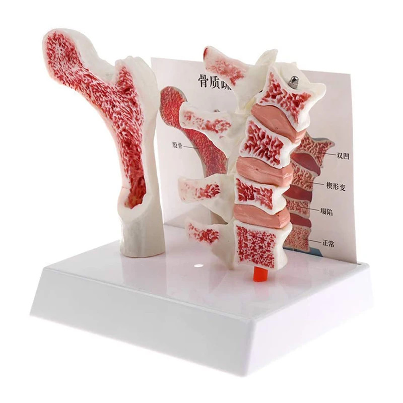 Human Femur Osteoporosis Anatomy Model Medical Teaching Resources Drop Shipping