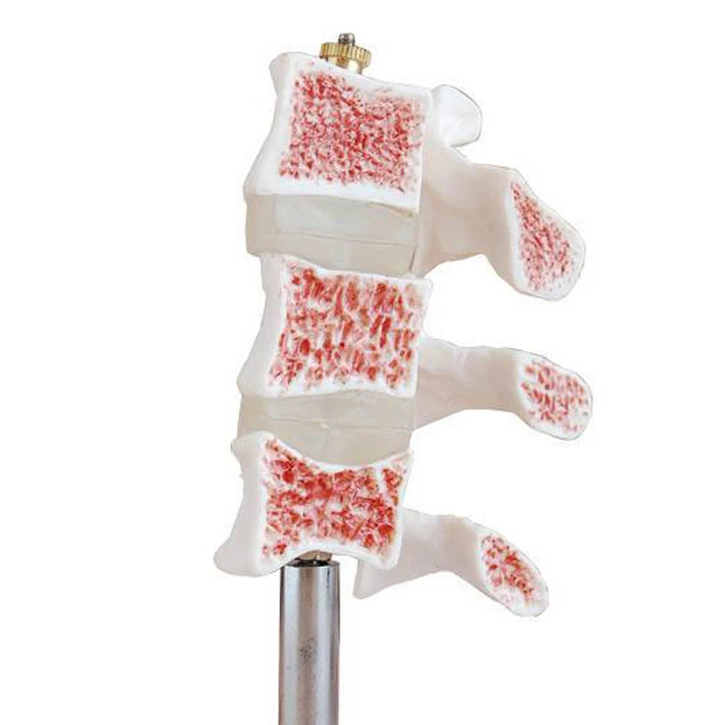 Osteoporosis Model Spine Typical Lesion Model Human Spine Model Osteoporosis Model
