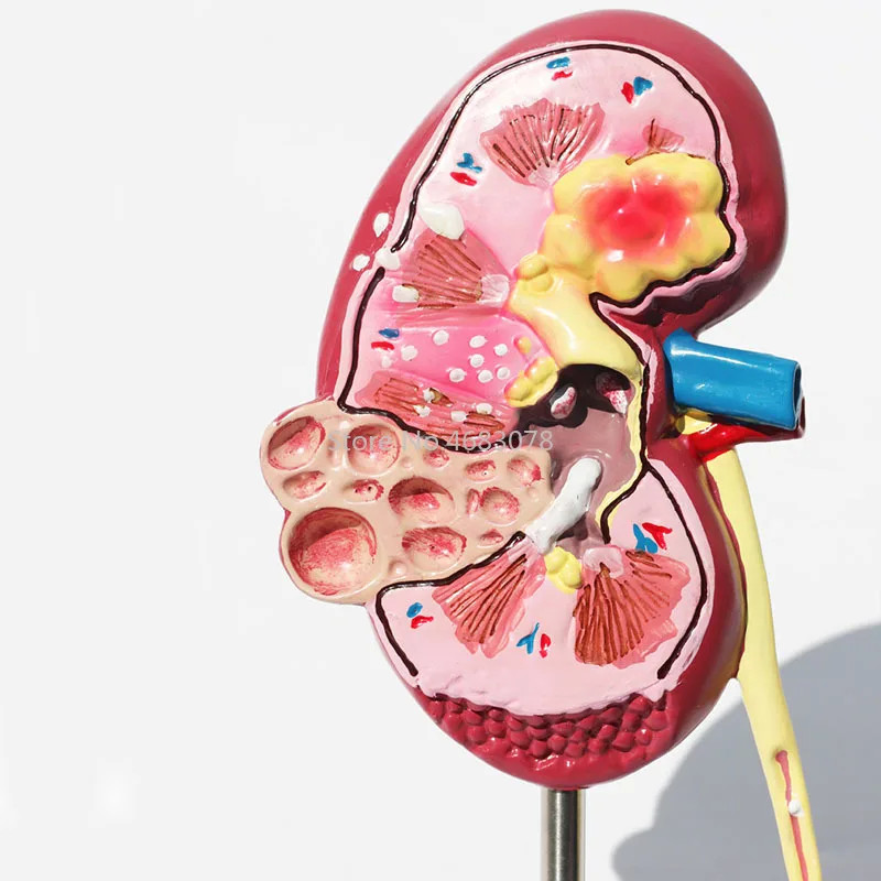 Human Body Organ Medical Kidney Anatomical Model Diseased Kidney  Model Human Anatomy Teaching Supp