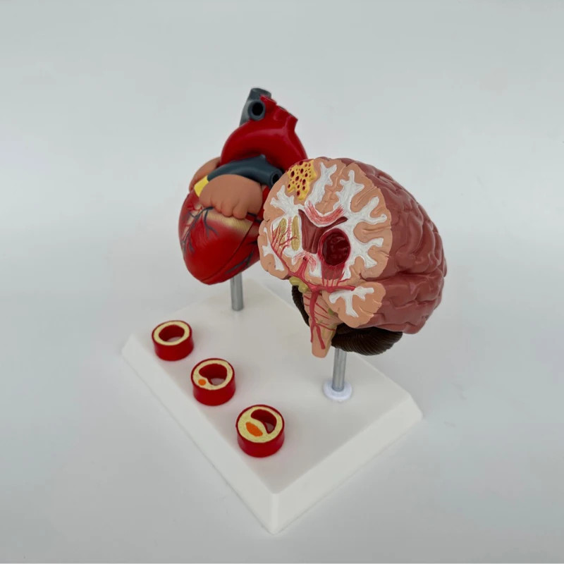 Human brain anatomy, brain pathology, diseases, cerebrovascular diseases, brain models, cardiovascu