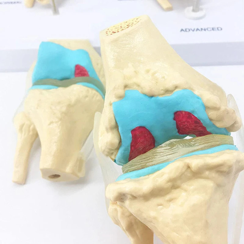 Four-stage Human Pathological Knee Joint Anatomy Model Medical Science Teaching Resources Dropshipp
