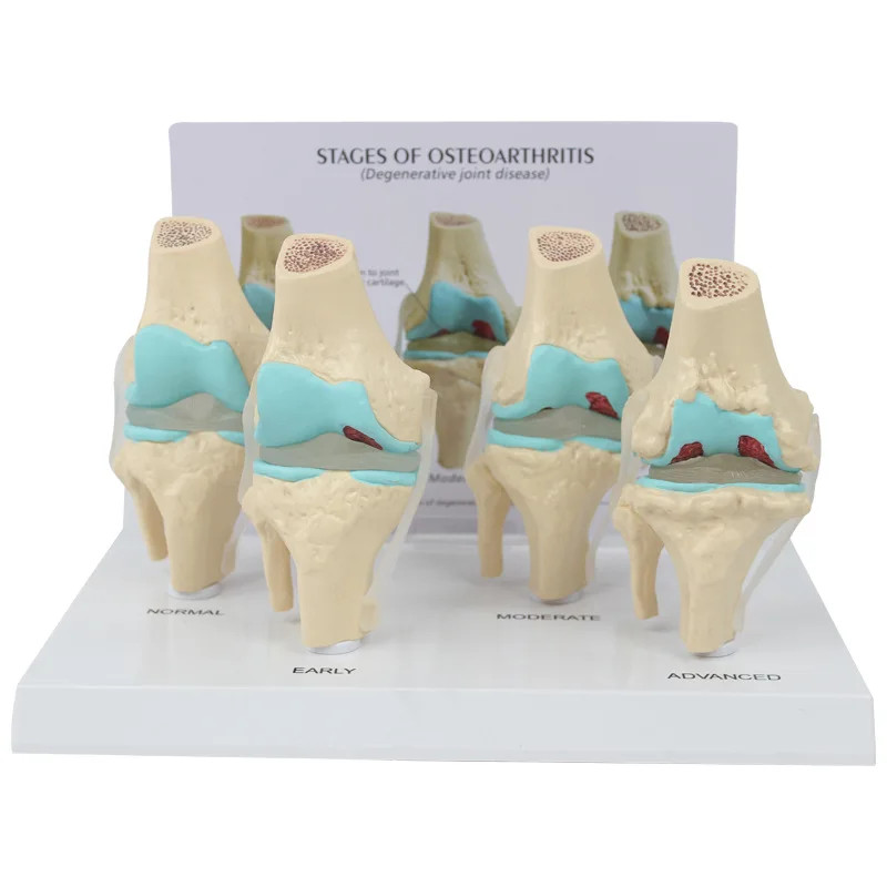 Anatomical Human Degenerative 4-stage Knee Joint Disease Model Medical Skeleton Anatomy Teaching Re