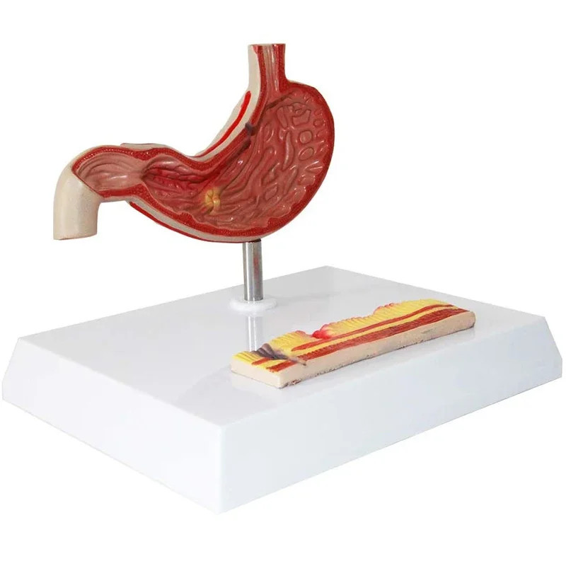 Human Anatomy Anatomy Stomach Medical Model Stomach Pathology Gastritis Ulcer Anatomy Medical Teach