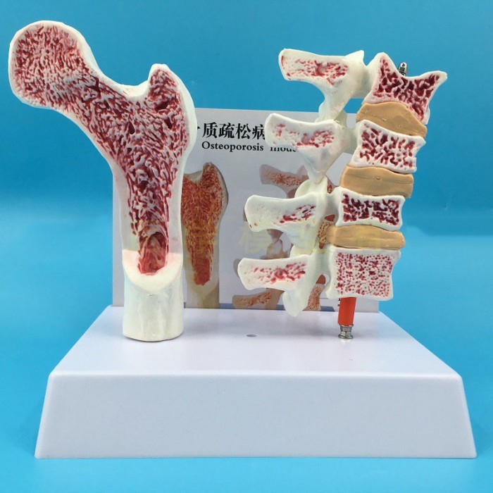 2 parts PVC Human Anatomical Model Osteoporosis Femur Leg Bone Spinal Section Specimen Diseased Lum