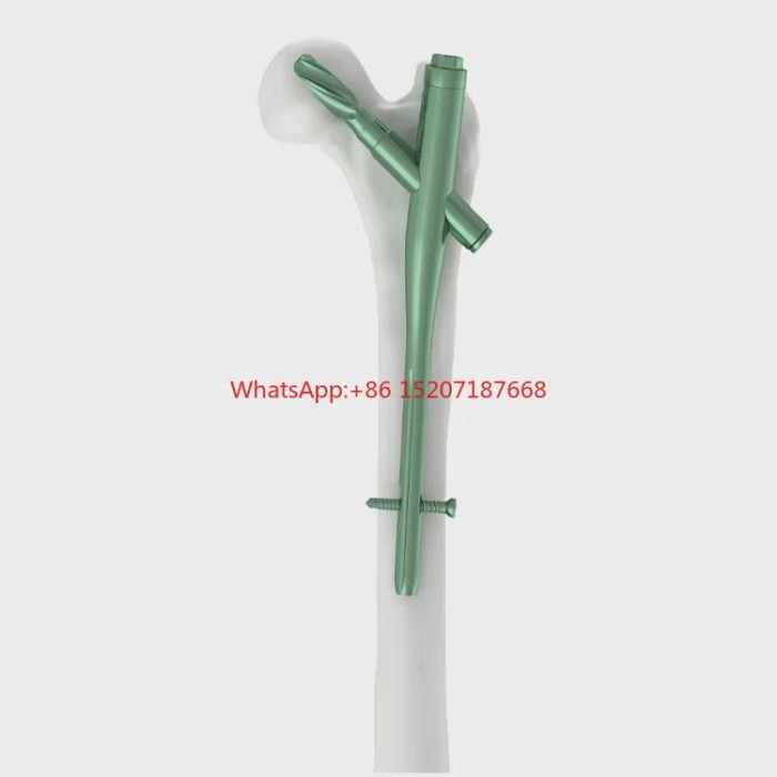 Competitive Price Gamma Nails PFNA Proximal Femoral Nail Antirotation Titanium Femur Intramedullary