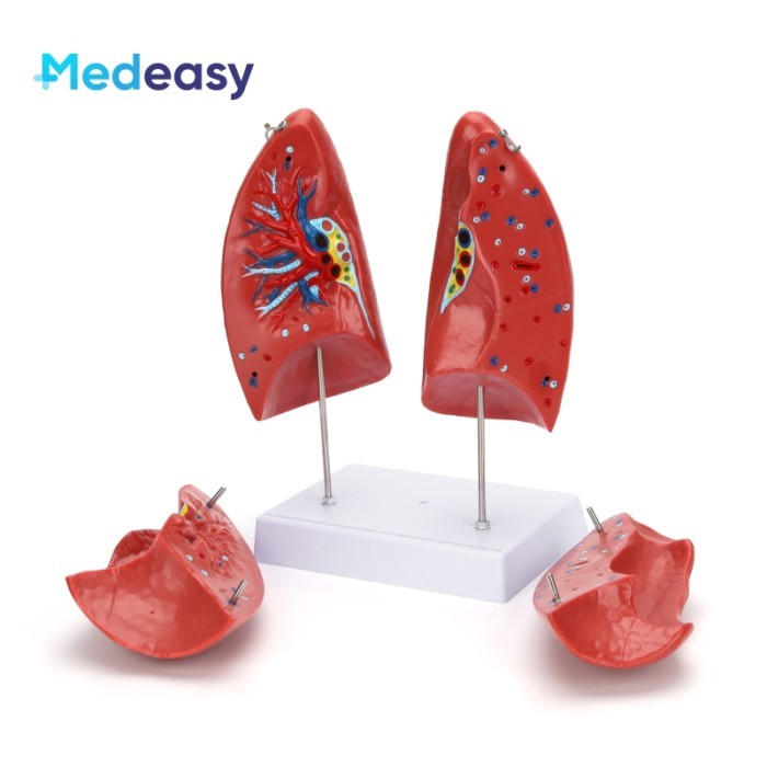 Detachable Human Anatomy Lung Anatomical Model