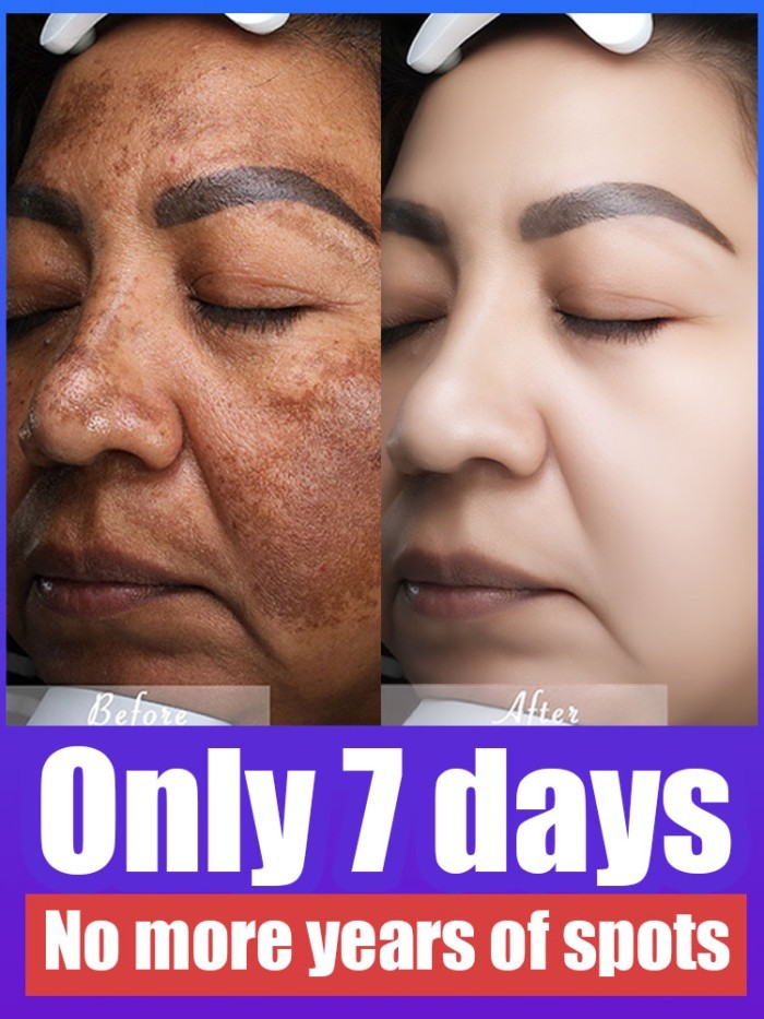Powerful Cream Fast Skin Lightening Solve Melasma Dark Spots Suitable for all ages