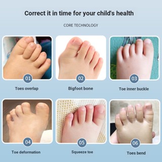 [Toe Corrector] [Thumb Valgus] อุปกรณ์แยกนิ้วเท้า ขนาดใหญ่ สําหรับผู้ชาย และผู้หญิง