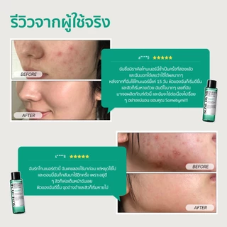 SOME BY MI AHA.BHA.PHA 30 Days Miracle Toner [30ml/150ml], โทนเนอร์ปรับสภาพผิว, การดูแลปัญหาสิว