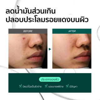 SOME BY MI AHA.BHA.PHA 30 Days Miracle Serum [50ml], บรรเทาสิว, เซรั่มรักษาสิว