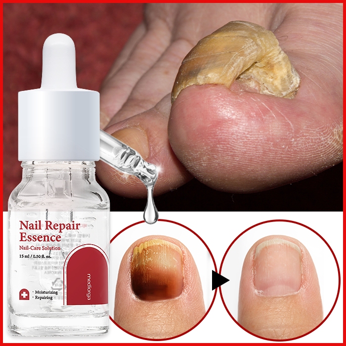 Mediorga Nail Hypoallergenic Problem Nail Intensive Care Nutrition Serum Repair Essence