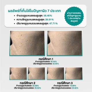 เซรั่ม Niacinamide 20% ลดรูขุมขน คุมมัน ลดสิว กระชับรูขุมขน Pore Minimizing Serum 40ml PORECENT