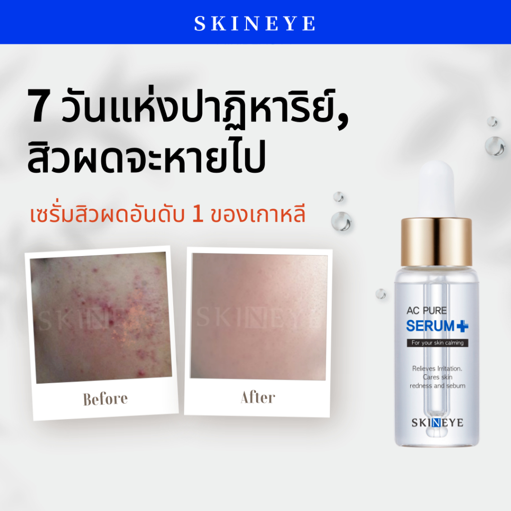 [SKINEYE] Ac Pure Serum - 20ml, Korean Pimple Acne Serum Skincare Treatment Moisturizer Pore Tightening Minimizer Salicylic Acid