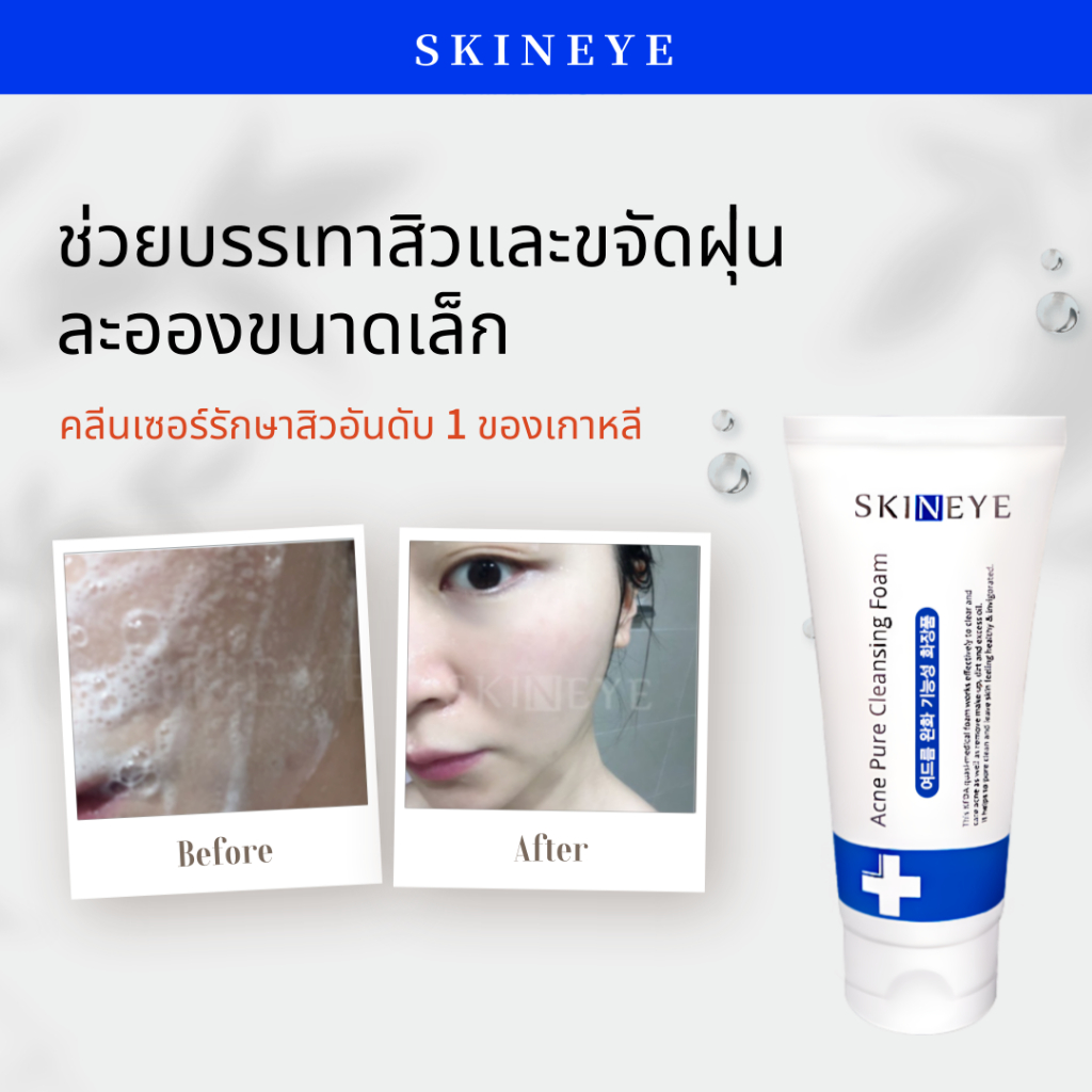 [SKINEYE] Ac Pure Cleanser Foam - 120ml, สิวเกาหลี Cystic Acne Facial Face Salicylic Acid Cleanser Skincare Treatment Pore Tightening Minimizer