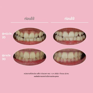 [EUTHYMOL] | เซตยาสีฟันสูตรฟันขาว แพ็ก 3 ชิ้น | สีชมพู 106g 2 ชิ้น + ม่วง 106g 1 ชิ้น | (แถมฟรี: ยาฟันสูตรขาว 20g * 1 + แปรงเพื่อขาว * 1 + ที่บีบยาสี * 1) | ปรับโทนสว่าง | แก้เหลือง | LG H&H OFFICIAL