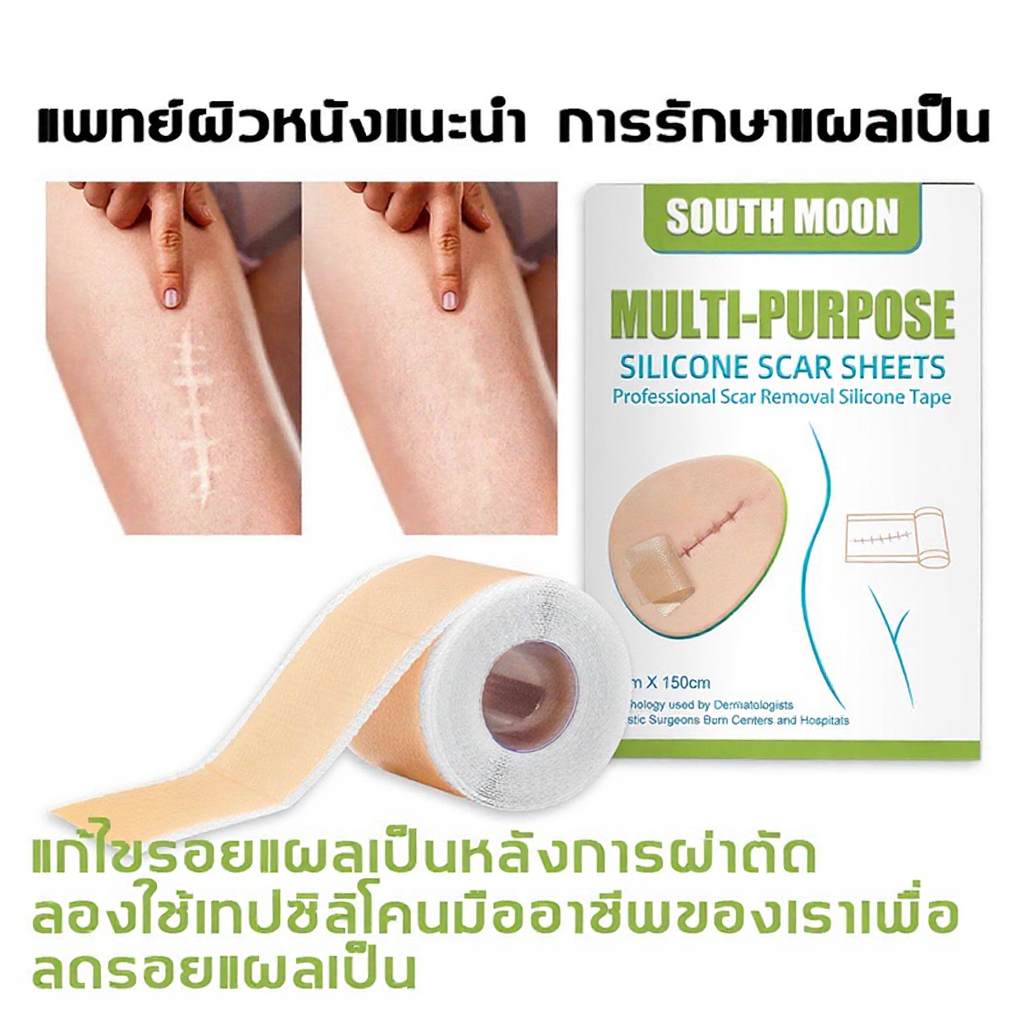 South Moon แผ่นแปะแผลเป็น 4cmx150cm กําจัดรอยแผลเป็นจากแผลเป็น