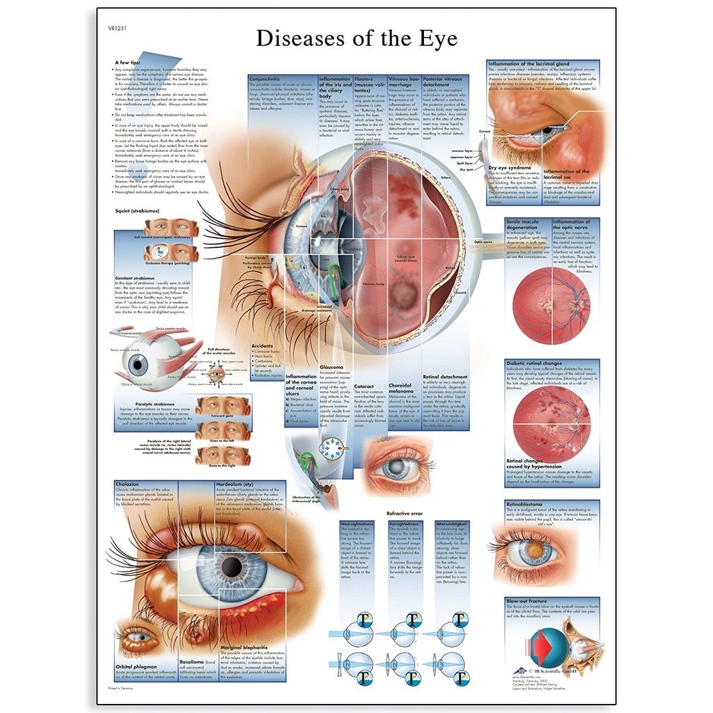 VRL Glossy Layer Pressed Paper Eye Disease Anatomy Chart Poster