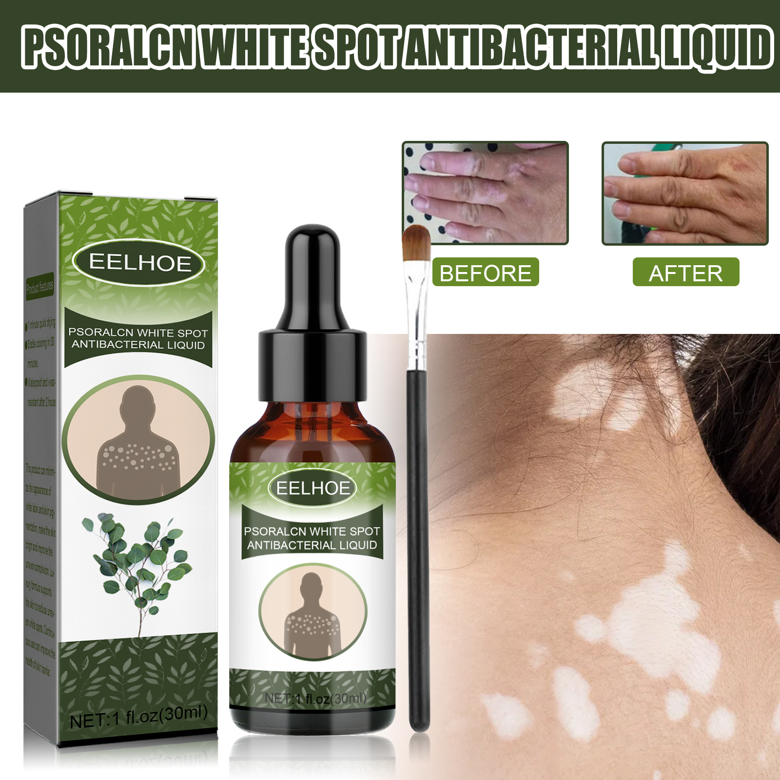 เซรั่มปรับสีผิวผิวด่าง 30 มล. - รองรับผิวด่างจุดขาวสําหรับใบหน้าและร่างกาย | สูตรปรับผิวให้สม่ําเสมอ ดูแลเม็ดสีผิว บํารุงผิว