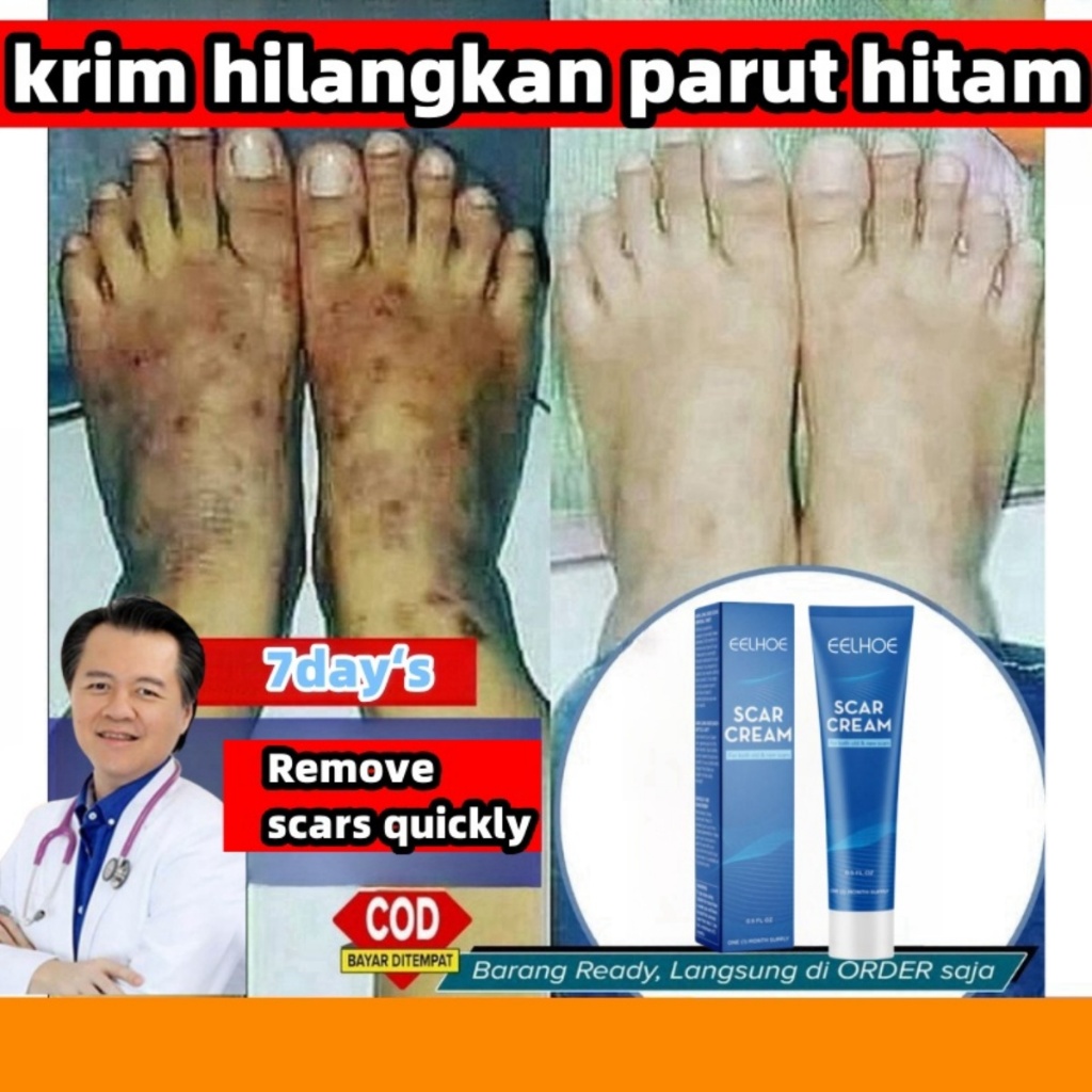 ครีมลบรอยแผลเป็น รักษาแผลจากยุงกัด แผลเป็นนูน สําหรับรอยดํา
