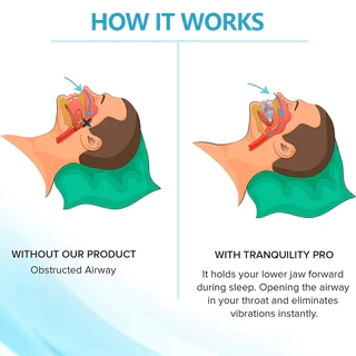 Comfort-Fit Night Guard สําหรับ Snoring & Bruxism - ส่งเสริมการนอนหลับอย่างสงบพร้อมบรรเทาที่ปรับแต่งได้สําหรับการหยุดหายใจการนอนหลับที่นุ่มนวลและระบายอากาศได้ดี