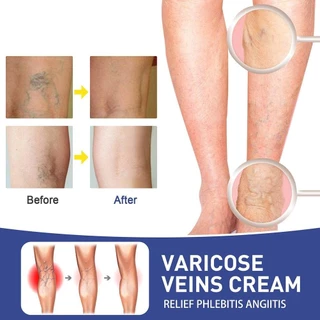 แผ่นแปะรักษาเส้นเลือดขอด Varecose Vein Remover ช่วยส่งเสริมการไหลเวียนโลหิต - 28793503672