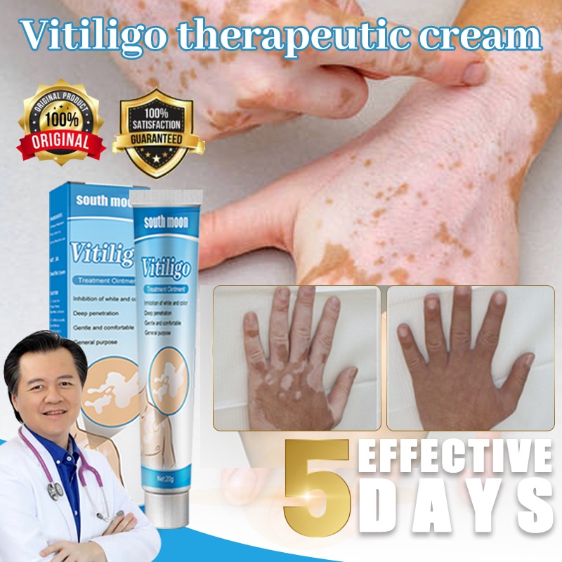 ครีมรักษาด่างขาวเฉพาะที่ โรคเชื้อรา จุดขาว 20g - ครีมกําจัดจุดขาว อัปเกรด
