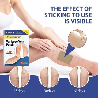 แผ่นแปะรักษาเส้นเลือดขอด Varecose Vein Remover ช่วยส่งเสริมการไหลเวียนโลหิต - 28793503672