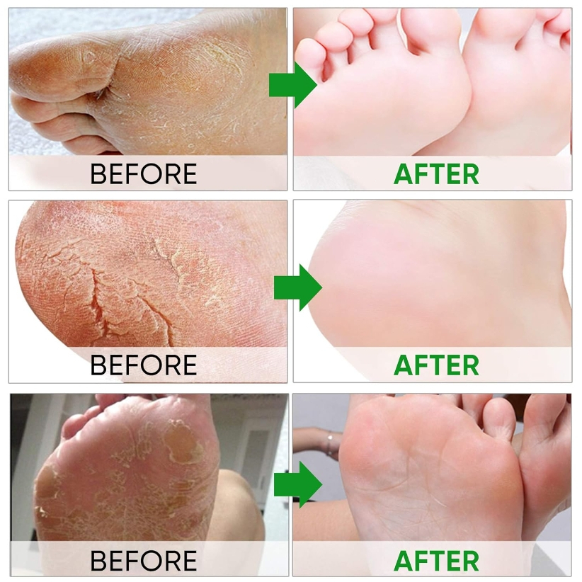 ซื้อ 2 แถม 1 ฟรี – สเปรย์ลอกผิวเท้าด้วยน้ํามันส้ม 100 มล., สเปรย์ขัดผิวเพื่อขจัดผิวที่ตายแล้ว, สเปรย์ให้ความชุ่มชื้นสําหรับดูแลเท้า ราคา ถูกที่สุด ดีลบีเคเค แกลเลอรีภาพที่ 6