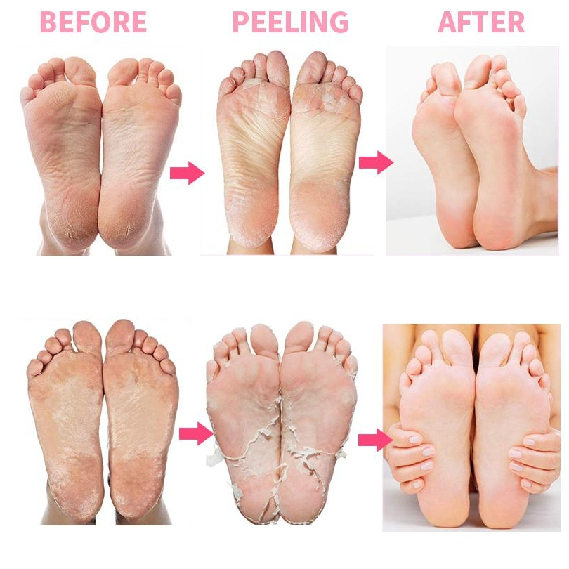 ซื้อ 2 แถม 1 ฟรี – สเปรย์ลอกผิวเท้าด้วยน้ํามันส้ม 100 มล., สเปรย์ขัดผิวเพื่อขจัดผิวที่ตายแล้ว, สเปรย์ให้ความชุ่มชื้นสําหรับดูแลเท้า ราคา ถูกที่สุด ดีลบีเคเค แกลเลอรีภาพที่ 5