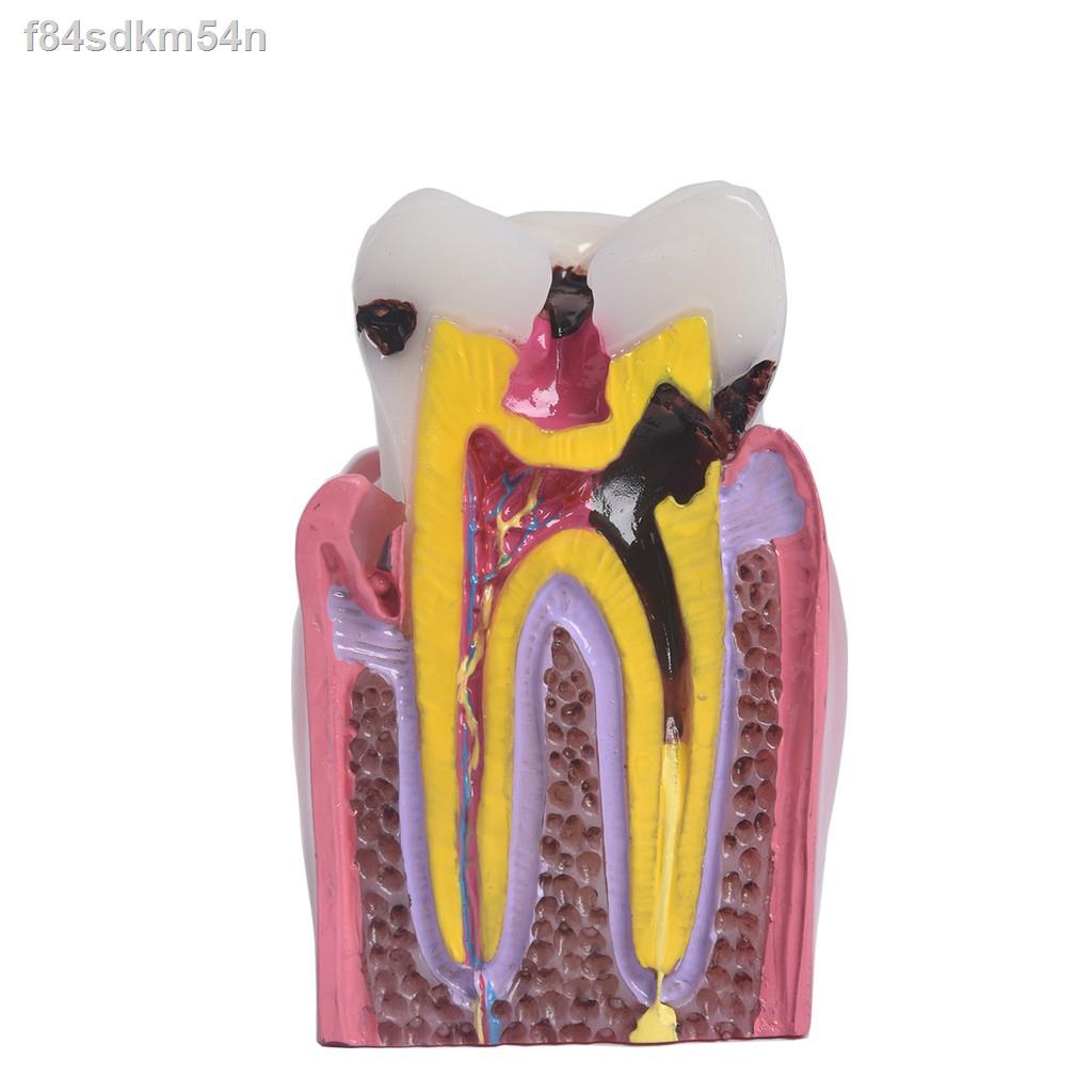 DENTAL Decay Teeth Comparation Study Model 6 Times Caries Tooth Teaching Tools
