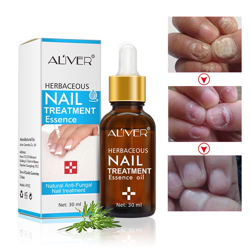 ALIVER เซรั่มบำรุงเล็บ เซรั่มเล็บ เล็บขบ เชื้อรา 30ml บำรุงเล็บ เชื้อราเล็บมือ ลากับเล็บเสีย ห่างกับปัญหาเล็บ ซ่อมแซมเล็บ ราคา ถูกที่สุด ดีลบีเคเค แกลเลอรีภาพที่ 5