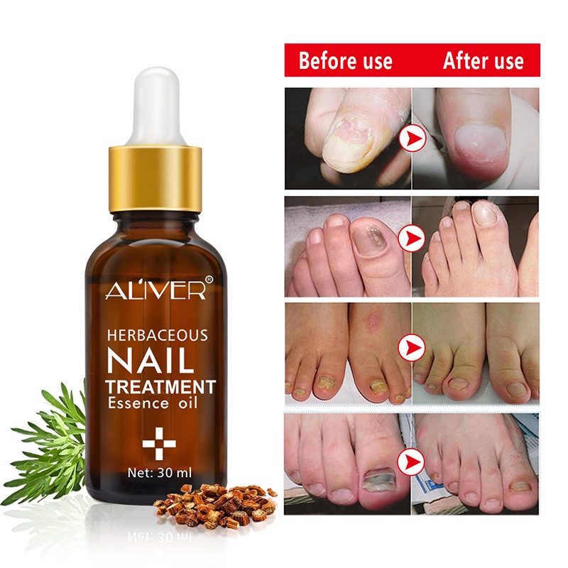 ALIVER เซรั่มบำรุงเล็บ เซรั่มเล็บ เล็บขบ เชื้อรา 30ml บำรุงเล็บ เชื้อราเล็บมือ ลากับเล็บเสีย ห่างกับปัญหาเล็บ ซ่อมแซมเล็บ ราคา ถูกที่สุด ดีลบีเคเค แกลเลอรีภาพที่ 6