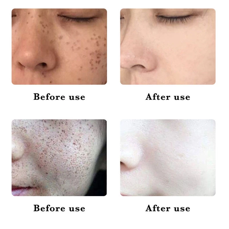 SADOER เซรั่มลดฝ้ากระ ลดสิว หน้าขาว 30ml thumbnail 6