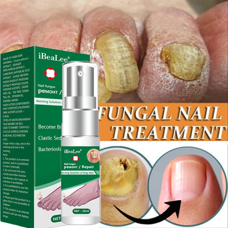 Nail Fungus Treatment Serum Anti-Infection Onychomycosis Paronychia Repair Essence สเปรย์กำจัดเล็บ Fungal Toe Hand Foot