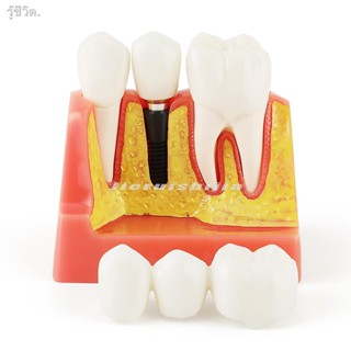 Dental Demonstration Teeth Model Implant Analysis Crown Bridge for Dentist