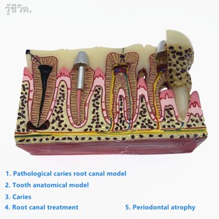 Teeth model Dental caries anatomical pathological model tooth nerve tooth model for Dental Teaching Training