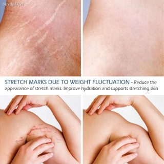 Stretch Marks Remover Essential Oil Skin Care Treatment Cream for Stretch Mark Removal Maternity Slackline for Pregnant