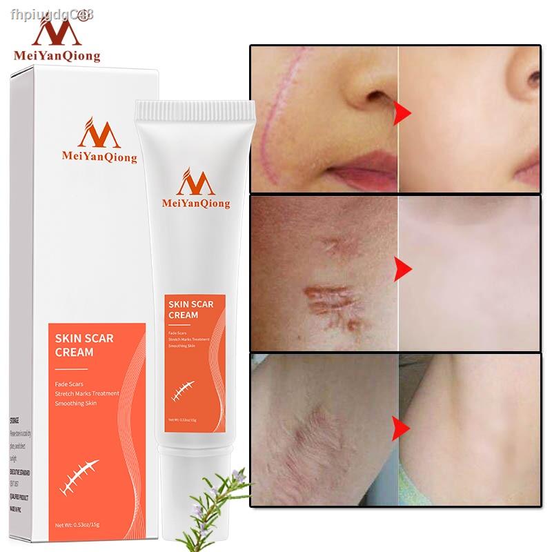 MeiYanQiong Scar Removal Cream Gel Stretch Marks Remove Acne Spots Burn Surgical Scars Treatment Smooth Whitening Face B
