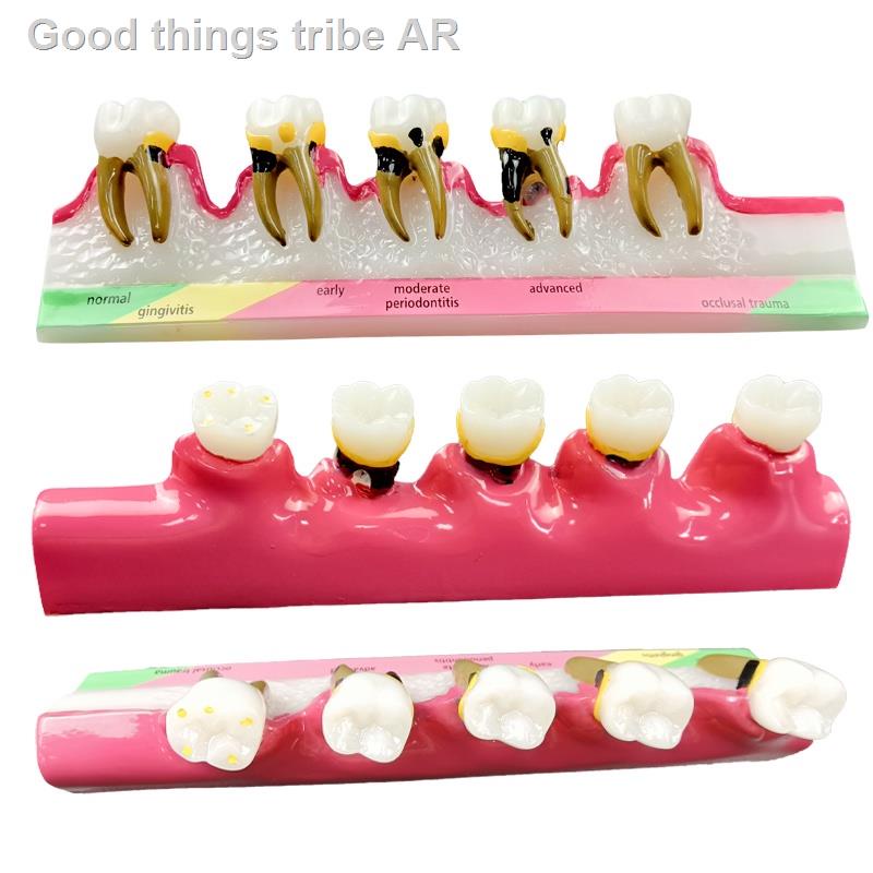 Teeth Model Caries Classify Pathological Model Tooth Caries Evolution 5 Stage Demo Model Dental Mode