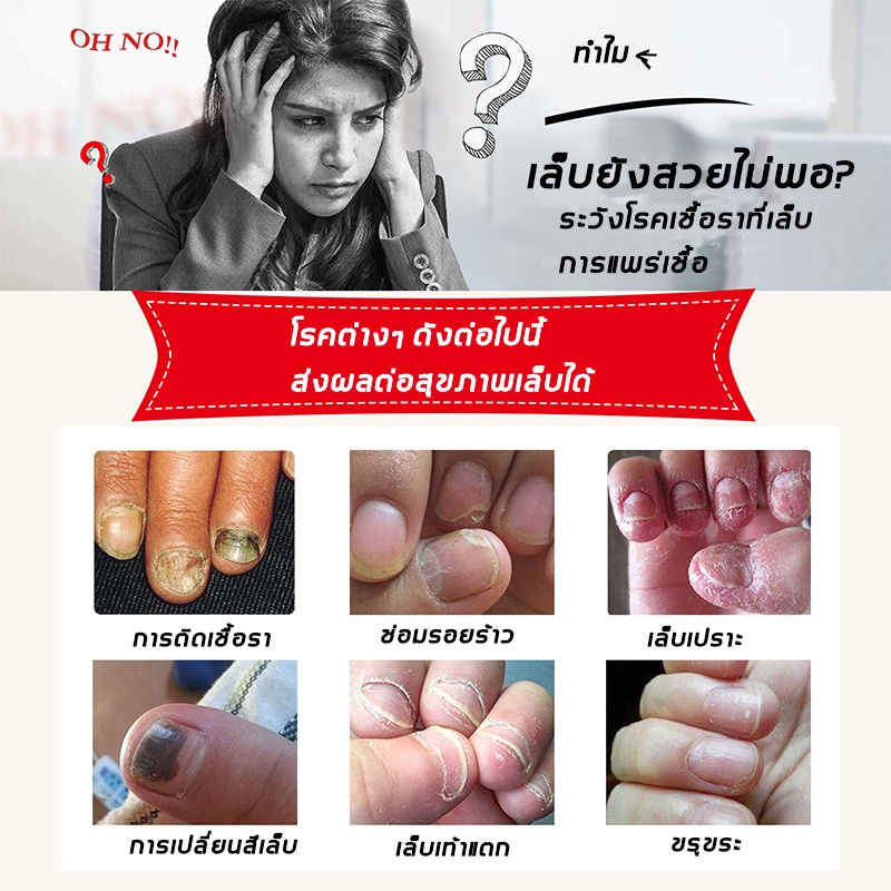 ALIVER เซรั่มบำรุงเล็บ เซรั่มเล็บ เล็บขบ เชื้อรา 30ml บำรุงเล็บ เชื้อราเล็บมือ ลากับเล็บเสีย ห่างกับปัญหาเล็บ ซ่อมแซมเล็บ ราคา ถูกที่สุด ดีลบีเคเค แกลเลอรีภาพที่ 2