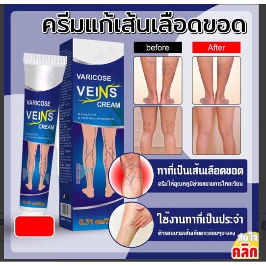Varicose veins cream ครีมลดเส้นเลือดขอด-ขนาดท20g