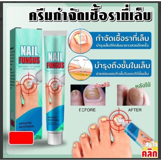 Nail fungus repair paste ครีมกำจัดเชื้อราที่เล็บ