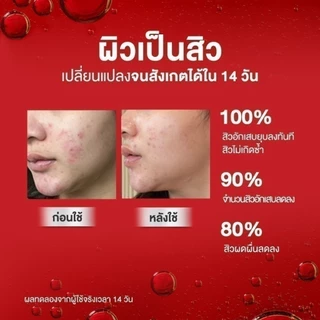 [6 ซอง] Skinsista บูสเตอร์ เซรั่ม เคลียร์สิว สิวยุบ ใน 7 ชม. Perfect Clear Booster 5ml.