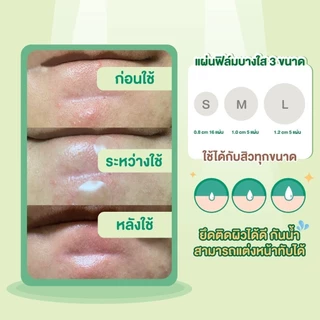Mentholatum Acnes Dressing (Sterile) 26pc เมนโทลาทั่ม แอคเน่ส์ แผ่นดูดซับของเหลวและความมันจากสิว 26ชิ้น 1หน่วย