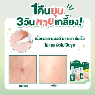 Mentholatum Acnes Anti-Acne Spot Gel 18g เมนโทลาทั่ม แอคเน่ส์ แอนไท-แอคเน่ สปอต เจล 18ก. เจลแต้มสิวฉุกเฉิน 1 หน่วย