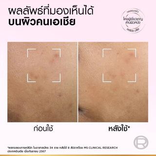 แพคคู่ ลอรีอัล ปารีส Glycolic Bright Anti-Dark Spot Exfoliant Peel 25ml พีลลิ่งมาส์กชมพู ผลัดเซลล์ผิวลดจุดด่างดำ