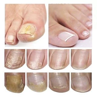 LANBENA Nail Essence ยาทาเล็บป้องกันเชื้อรา เซรั่มซ่อมแซมเล็บ 15ml