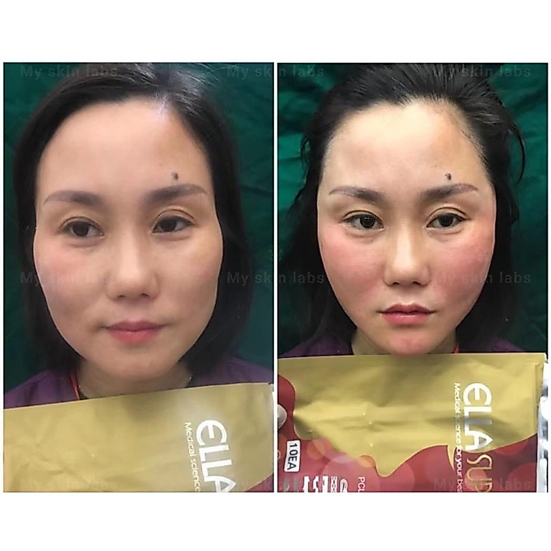 Elle Germany นําเข้า Line Cheng face-lifting v-face Handy Tool 18x100 Super Firm ลบริ้วรอย