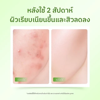[เซต] The Originote Acne Bundle moisturizer serum เซรั่ม เซ็ตรักษาสิว