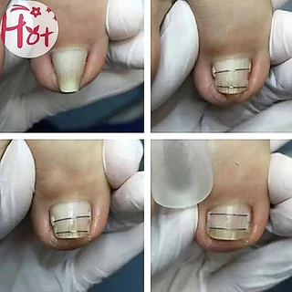 GE เครื่องมือแก้ไขเล็บเท้าคุดเล็บเท้ากู้คืนฝังนิ้วเท้ารักษาเล็บคุดยืดคลิปรั้งสแควร์